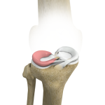 Lateral Meniscus Syndrome