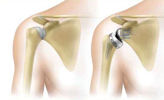 reverse total shoulder replacement